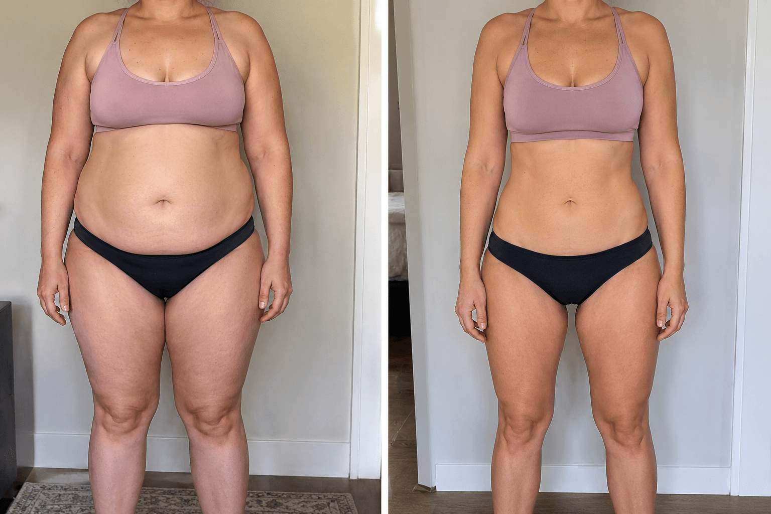 Before and after of a weight management case with GLP-1 treatment